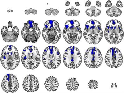 Regional Cerebral Blood Flow Abnormalities in Neurosyphilis: A Pilot SPECT Study